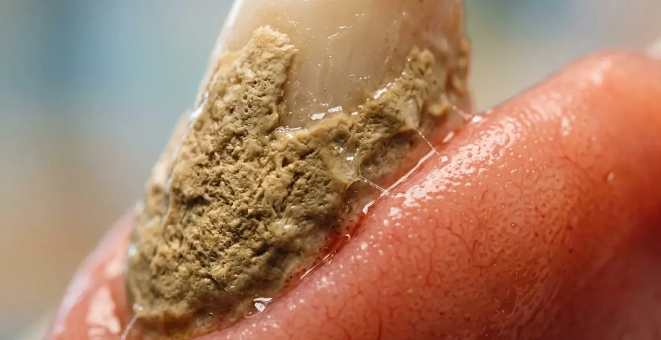 Vue macro des dépôts de tartre dentaire illustrant le lien avec les infections cardiaques